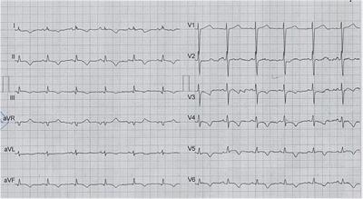 Retrosternal hematoma causing torsade de pointes after coronary artery bypass graft surgery; a case report